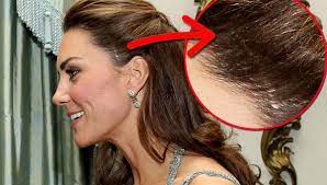 Middleton was credited with helping to persuade william not to drop out of university at the end of his lonely first. Herzogin Kate Aufgefallen Sie Hat Eine Grosse Narbe Am Kopf Bunte De