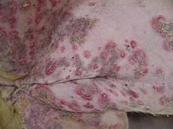 Image result for Pemphigus