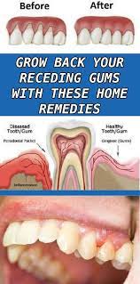 This Is A Common Dental Problem Because Of Its Subtle Start It Occurs So Gradually So There Are A Lot Of P Receding Gums Teeth Health Natural Health Remedies