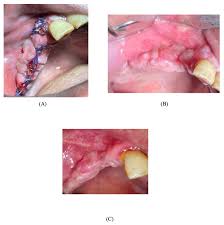Image result for granuloma gum disease