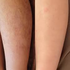 小学1年生Yちゃん膝下脱毛 | 横浜青葉台シミ毛穴たるみ改善専門のエステ美キュート