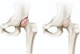 Poftiți la nunta, totul este gata! Recomandari Pentru Pacientii Cu Proteza Totala De Sold Dr Radu Fleaca Tratament De Scurgere A È™oldului