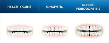 Image result for Periodontitis