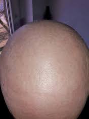 Although hair loss caused by chemotherapy is usually temporary, many patients with cancer consider it one of the most distressing side effects of treatment. Hair Loss Through Chemotherapy Alopecia Medicamentosa Thymuskin