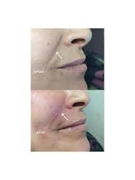 filler Dr. Aline Yousef