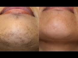 Pin By Blkgrlmagic On Makeup Lotions Potions Chin Hair Skin Care Skin Bleaching Cream
