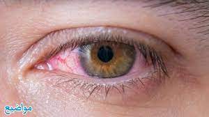 الحلم بان الميت يشتكى عدم الرؤية. ØªÙØ³ÙŠØ± Ø±Ø¤ÙŠØ© Ù…ÙŠØª ÙŠØ´ØªÙƒÙŠ Ù…Ù† Ø¹ÙŠÙ†Ù‡ ÙÙŠ Ø§Ù„Ù…Ù†Ø§Ù…