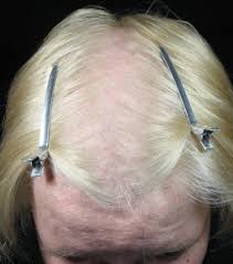 Using a dermaroller on a daily basis isn't effective, and it will likely make your hair loss worse. Introducing Microneedling To Regrow Your Hair Advanced Rejuvenation Medical Spa