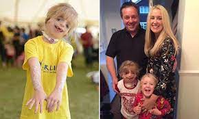 Menina Com Sindrome De Treacher Collins Ja Passou Por 29 Cirurgias No Rosto Ela E A Crianca Mais Feliz