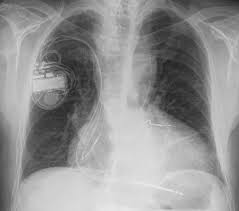 0212 986 06 50whatsapp i̇letişim: Kardiologie Herzschrittmacher Defibrillatoren Kardiale Resynchronisations Therapie