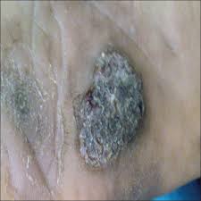 Meaning of tuberculosis verrucosa cutis medical term. Multifocal Tuberculosis Verrucosa Cutis Abstract Europe Pmc