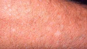 White Spots On Skin What S Causing It
