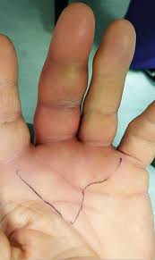 Image result for Hand Infection