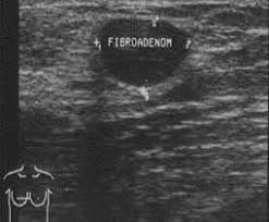 Brustkrebs Diagnostik Und Fruherkennung Sonographie Ultraschall