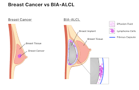 The brand offers silicone gel implants with with smooth surfaces only. Allergan Breast Implant Lawsuit Potential Links To Bia Alcl