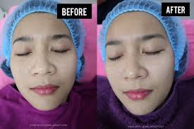 Para pakar dermatologi dan venereologi. Rawatan Wajah Pico Toning Laser Dual Yellow Di Klinik Pakar Kulit Dr Ko Juru Lia Hasty