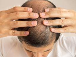 Telogen effluvium (te) is the most common cause of diffuse hair loss in adult females. Iron Deficiency Hair Loss Symptoms Treatment And Regrowth