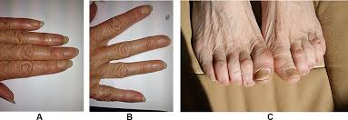 Image result for Yellow nail syndrome feet