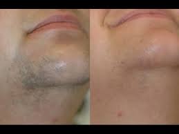 Myriam barrero started providing laser hair removal treatments in 1993. Transgender Laser Hair Removal Miami Fl Youtube