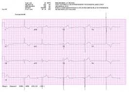 Third Degree Atrioventricular Block Complete Heart Block