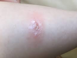 Les aoûtats sont des petits arachnides qui vivent dans les jardins et les prairies. Piqure D Insecte Journal Des Femmes