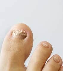 Check spelling or type a new query. Ingrown Toenail In Children 6 Causes And 7 Treatments