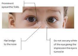 Epicanthal folds at the inner angle of the eyes are present. Pseudo Squint Hull University Teaching Hospitals Nhs Trust