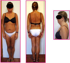 Image result for Lipodystrophy