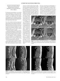 Presentación similar pero en el estudio electrofisiológico muestra compromiso axonal. Pdf Sindrome De Guillain Barre Hallazgos Por Resonancia Magnetica En Presentacion Clinica Atipica