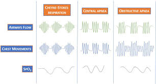 Image result for Cheyne-Stokes Respiration