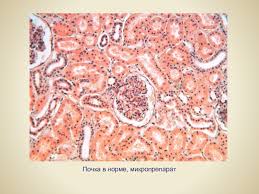 Картинки по запросу узелковый периартериит микропрепарат Glomerulyarnye Bolezni Pochek Patologiya Pochechnyh Klubochkov Pri Sistemnyh Zabolevaniyah Prezentaciya Doklad