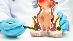 Image result for Hemorrhoid
