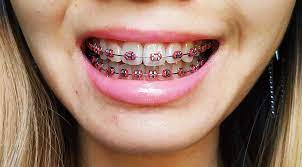 This is something that braces veterans forget. Half A Year In Braces