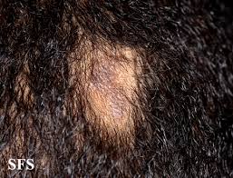 This is a type of scarring hair loss condition. Lichen Planus Wikidoc