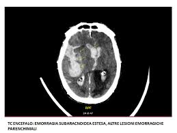 Come è già stato detto, solitamente è in relazione con emorragia subaracnoidea. Ictus Emorragico
