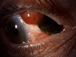 Image result for conjunctival melanoma