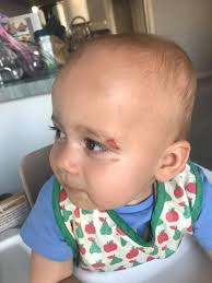 What to apply to a chafed and scabbed area