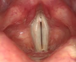 British Voice Association Reflux And Voice