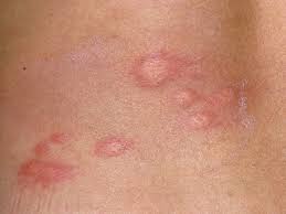 Image result for Papular urticaria