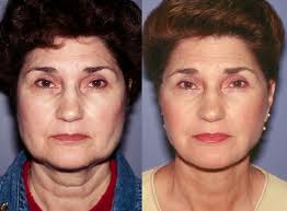 Bellevue Facelift Seattle Mini Facelift Cheek Lift Neck Lift Surgery But before getting into facelifts, let's look at how the skin on our faces age. neck lift surgery