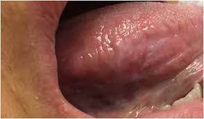 Image result for white cancer on tongue)
