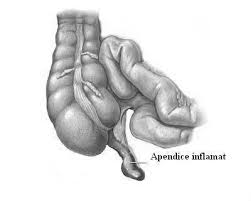 In tratamentul de urgenta pentru peritonita acuta se aplica metoda celioscopica care consta in. Apendicita Acuta Cauze Simptome Si Interventie Chirurgicala Medlife