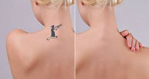 A laser technician will numb the tattooed skin with a local anesthetic. 4 Ways To Remove Your Permanent Tattoo Without Laser