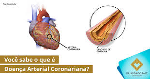 Doenca Arterial Coronariana Uma Visao Geral Da Doenca Dr Rodrigo Paez Cardiovascular