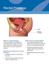 Image result for Rectal prolapse