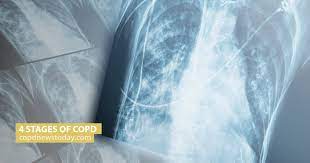 Check spelling or type a new query. 4 Stages Of Copd Copd News Today