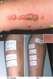 Image result for Cimex lectularius bites