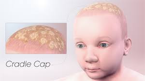 Image result for Cradle Cap