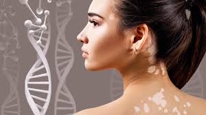 Image result for Vitiligo