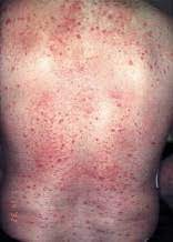 Psoriasis and eczema, especially atopic eczema, are two of the most common cutaneous conditions recalcitrant plaque psoriasis. Adult Onset Recalcitrant Eczema A Marker Of Noncutaneous Lymphoma Or Leukemia Sciencedirect